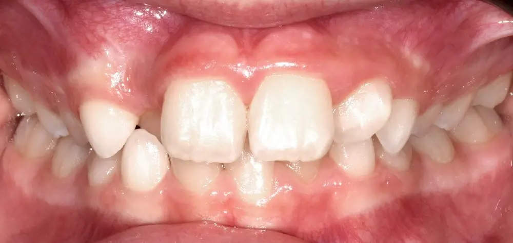 Детские кейсы - Кейс 1 — вид спереди до лечения