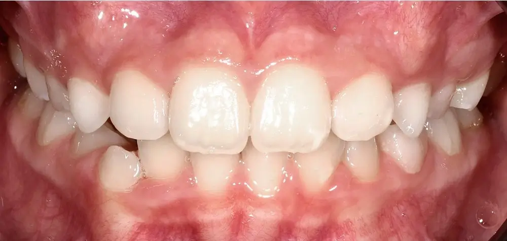 Детские кейсы - Кейс 1 — вид спереди после лечения