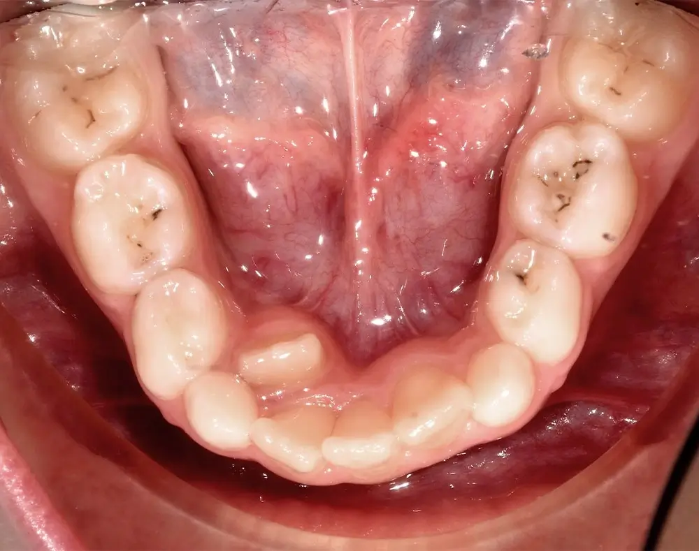 Детские кейсы - Кейс 1 — нижняя челюсть до лечения