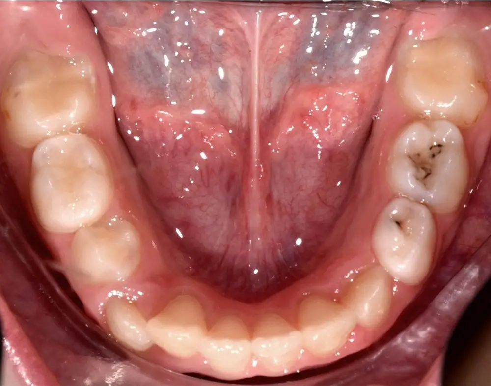 Детские кейсы - Кейс 1 — нижняя челюсть после лечения