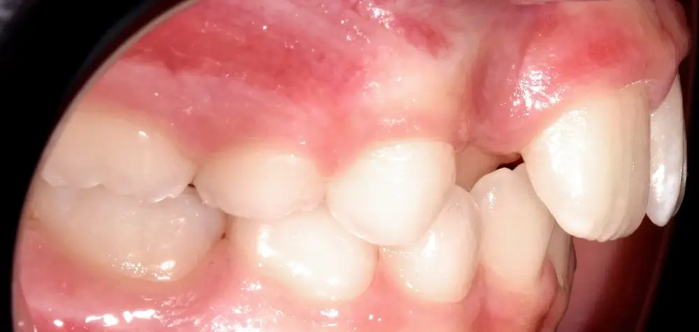 Детские кейсы - Кейс 1 — боковой ракурс до лечения