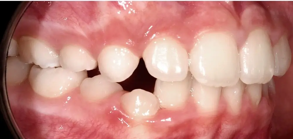 Детские кейсы - Кейс 1 — боковой ракурс после лечения