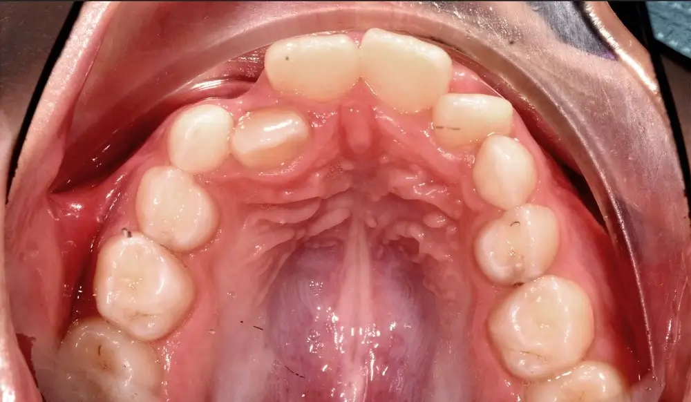 Детские кейсы - Кейс 1 — верхняя челюсть до лечения