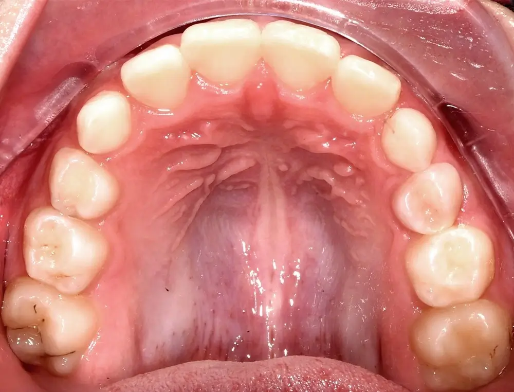 Детские кейсы - Кейс 1 — верхняя челюсть после лечения