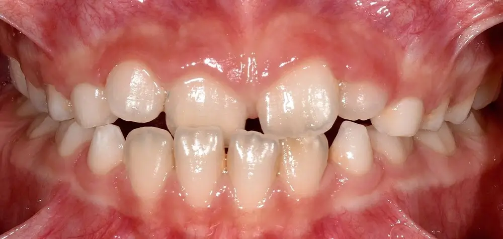 Детские кейсы - Кейс 2 — вид спереди до лечения