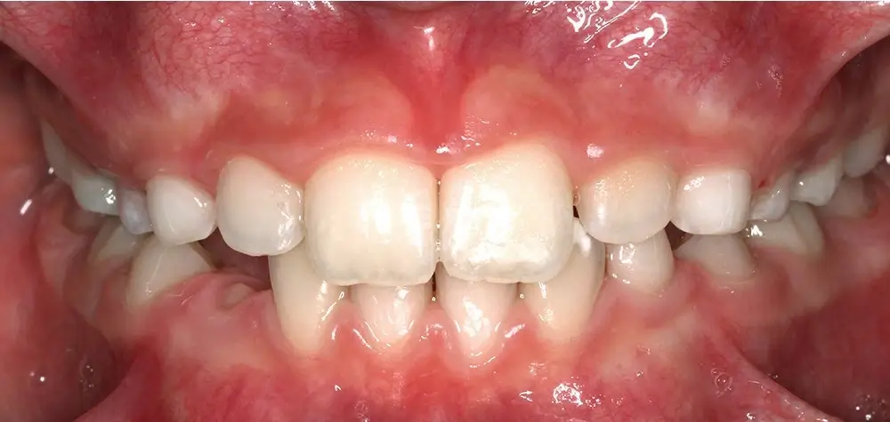 Детские кейсы - Кейс 2 — вид спереди после лечения