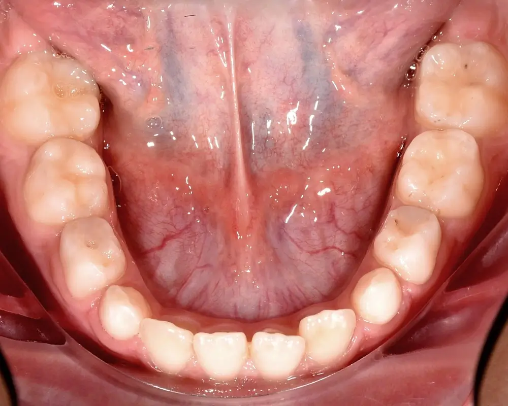 Детские кейсы - Кейс 2 — нижняя челюсть до лечения