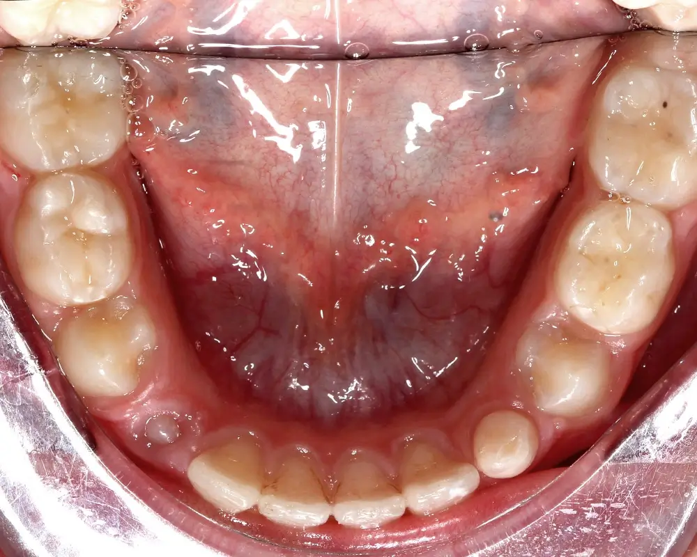 Детские кейсы - Кейс 2 — нижняя челюсть после л ечения