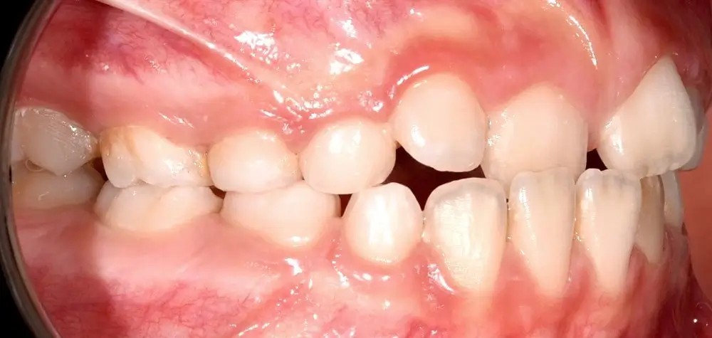 Детские кейсы - Кейс 2 — боковой ракурс до лечения