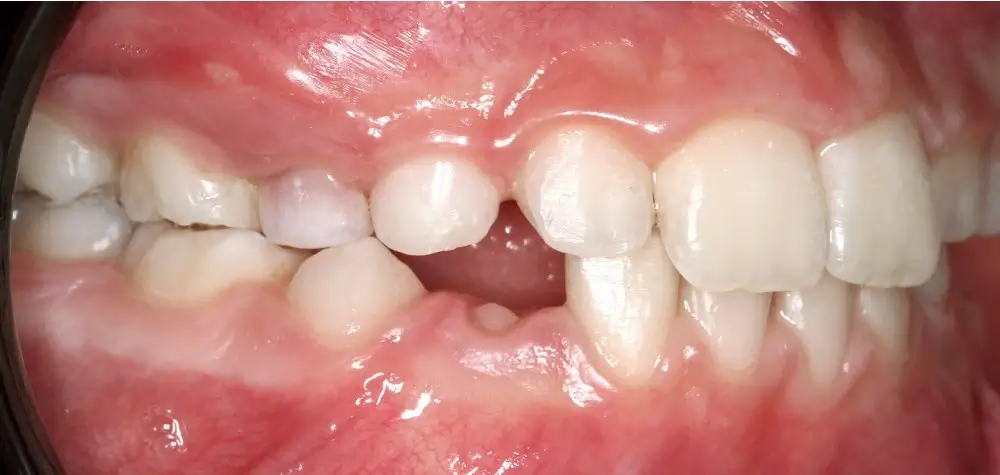 Детские кейсы - Кейс 2 — боковой ракурс после лечения