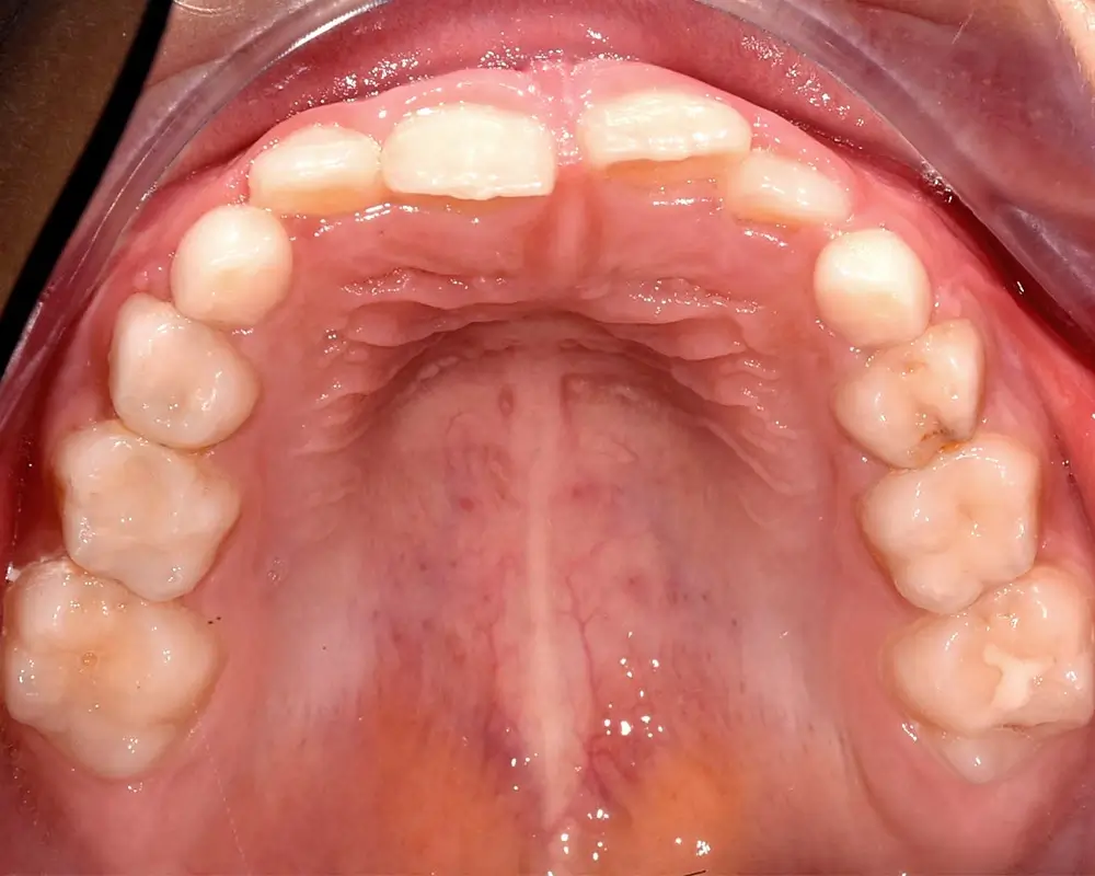 Детские кейсы - Кейс 2 — верхняя челюсть до лечения