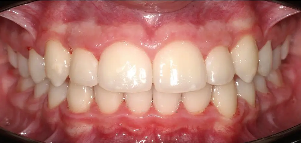 Детские кейсы - Кейс 3 — вид спереди после лечения