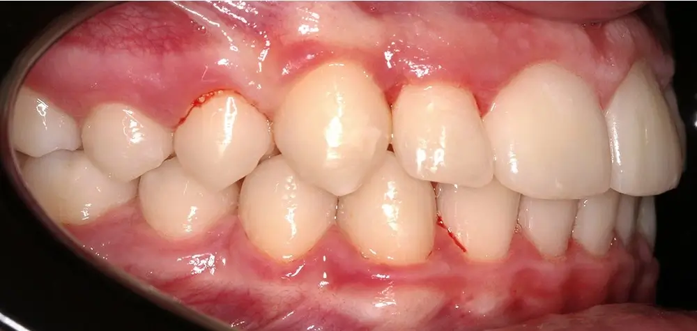 Детские кейсы - Кейс 3 — боковой ракурс после лечения