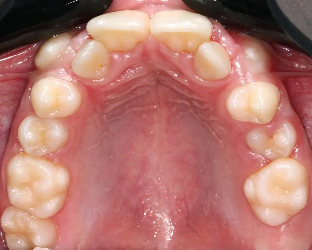 Детские кейсы - Кейс 3 — верхняя челюсть до лечения