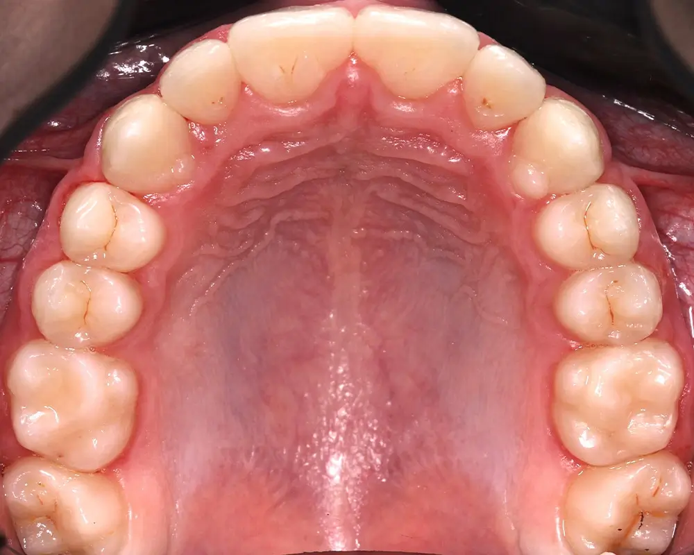 Детские кейсы - Кейс 3 — верхняя челюсть после лечения