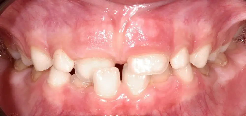 Детские кейсы - Кейс 4 — вид спереди до лечения