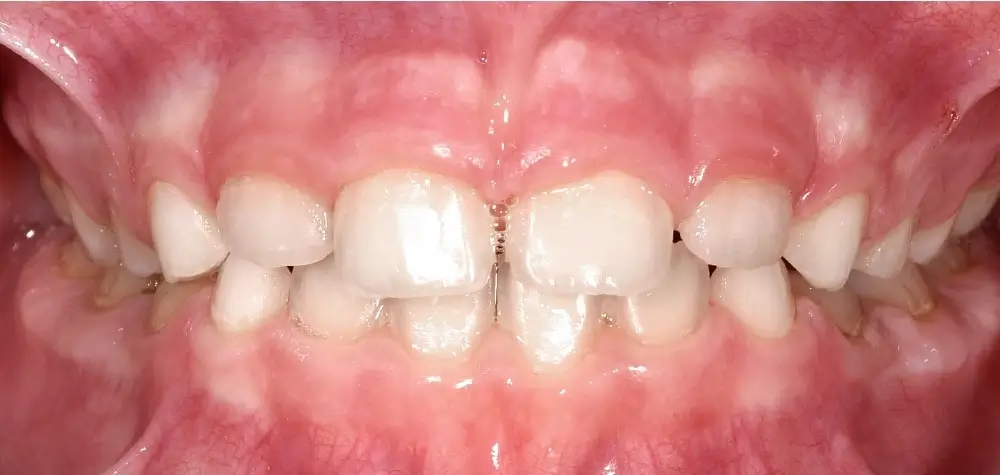 Детские кейсы - Кейс 4 — вид спереди после лечения