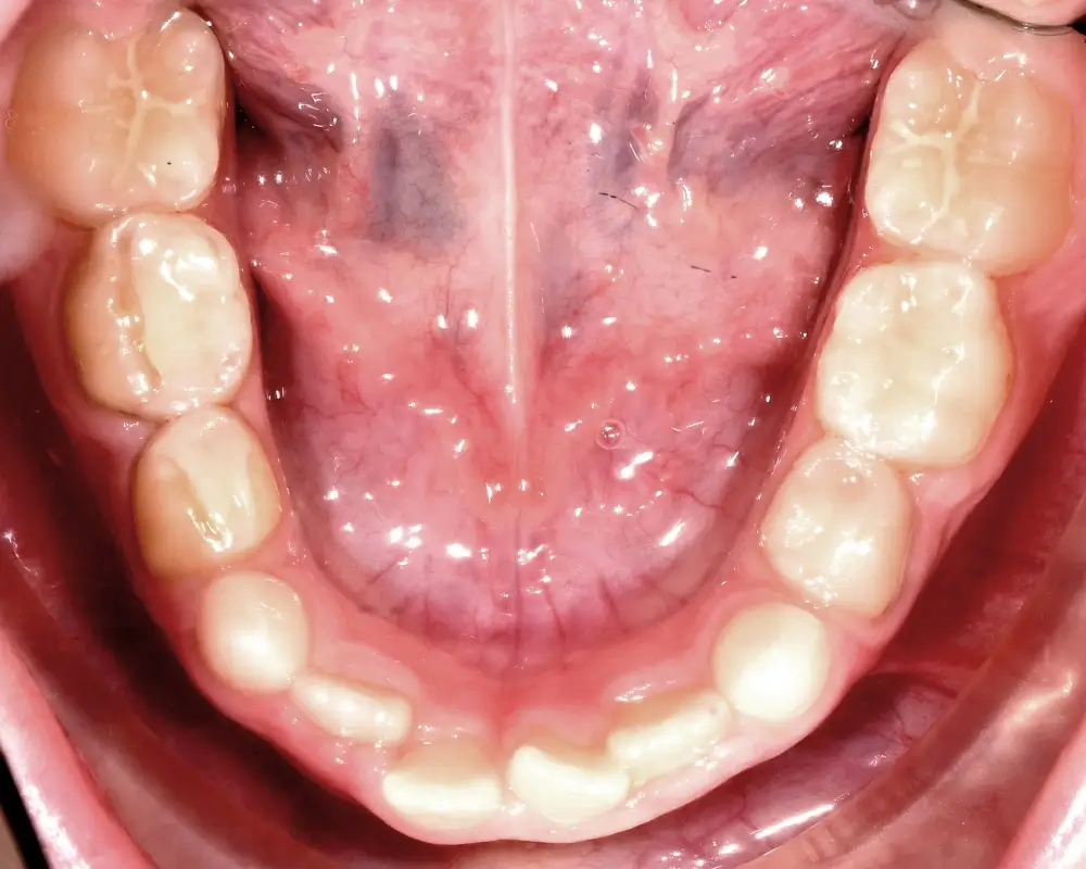 Детские кейсы - Кейс 4 — нижняя челюсть до лечения