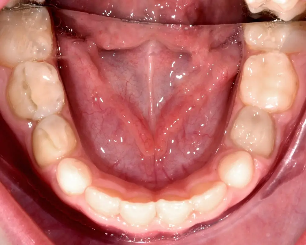 Детские кейсы - Кейс 4 — нижняя челюсть после лечения