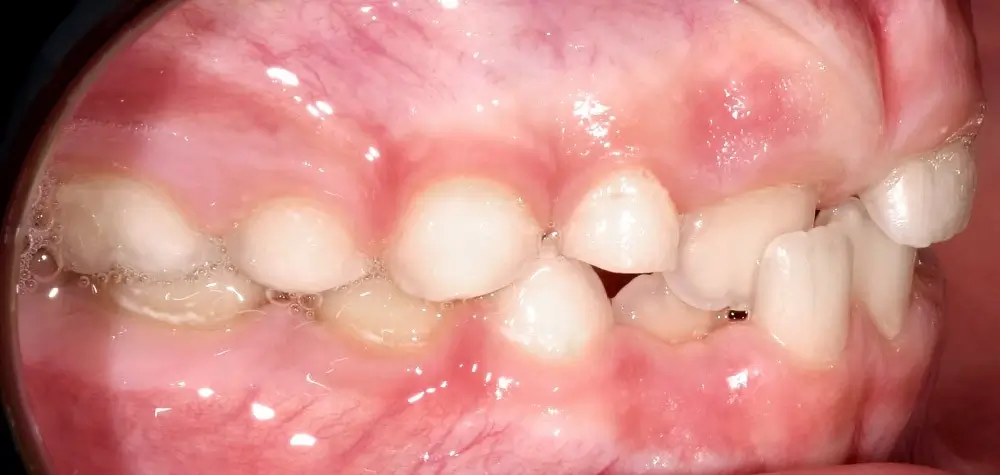 Детские кейсы - Кейс 4 — боковой ракурс до лечения