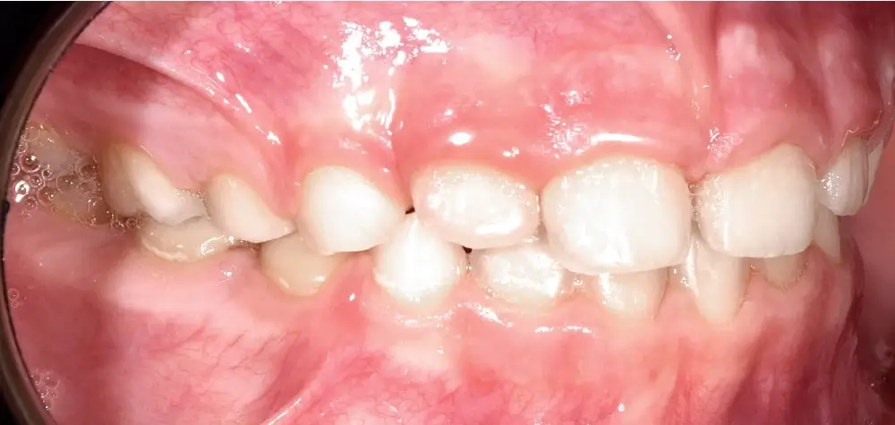 Детские кейсы - Кейс 4 — боковой ракурс после лечения