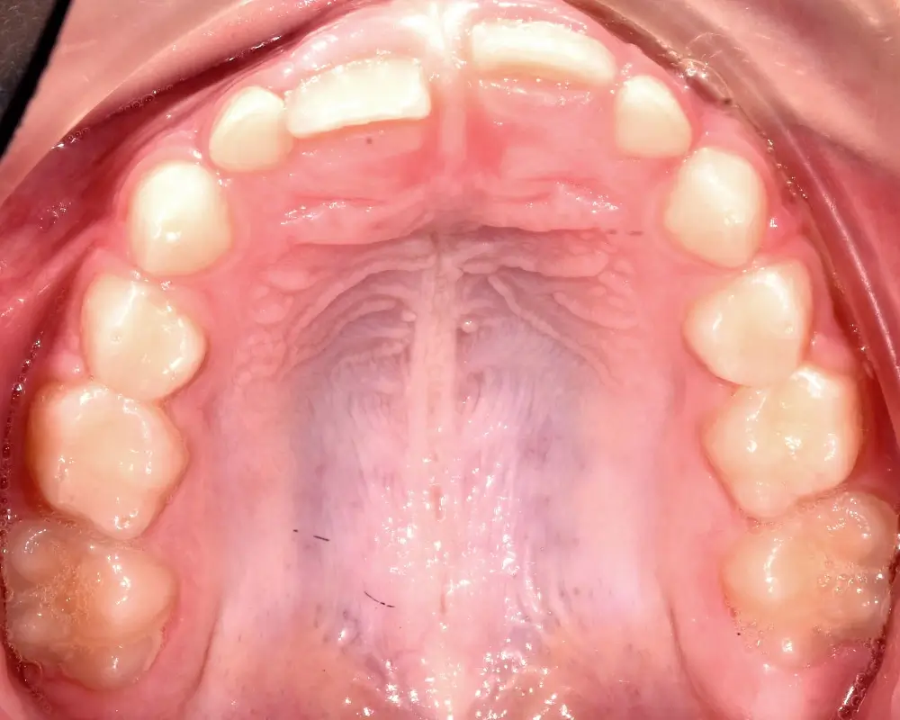 Детские кейсы - Кейс 4 — верхняя челюсть до лечения