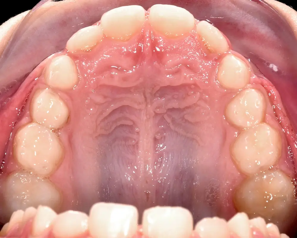 Детские кейсы - Кейс 4 — верхняя челюсть после лечения