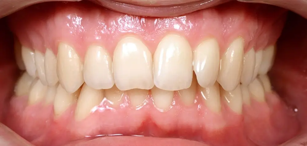 Дистальный прикус - Кейс 1 — вид спереди до лечения