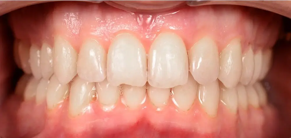 Дистальный прикус - Кейс 1 — вид спереди после лечения