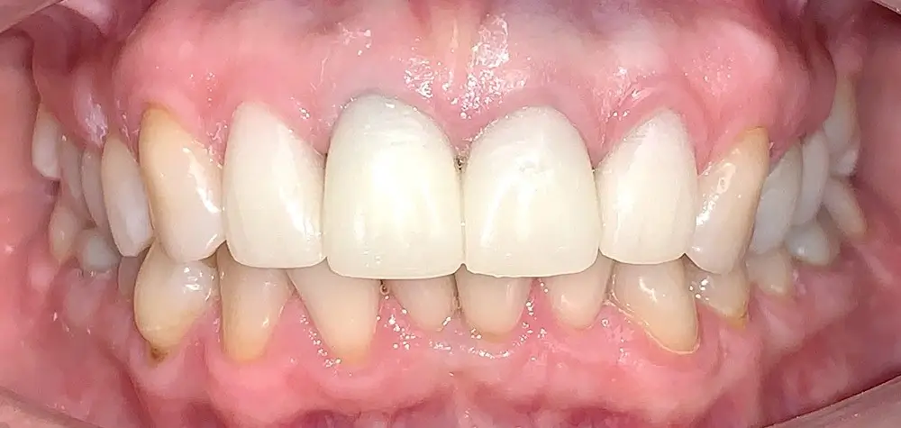 Дистальный прикус - Кейс 10 — вид спереди до лечения