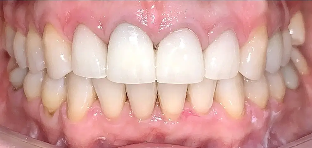 Дистальный прикус - Кейс 10 — вид спереди после лечения