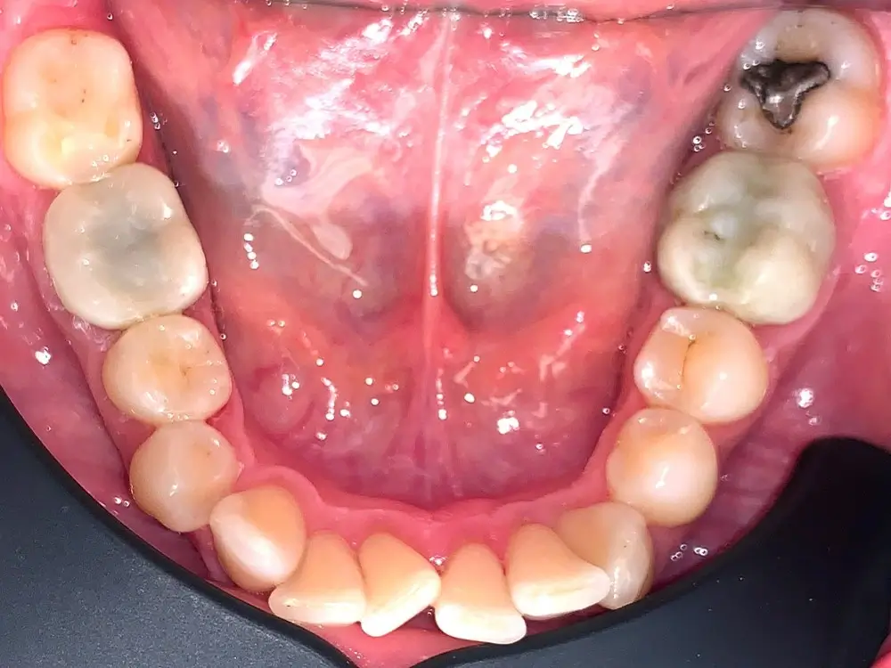 Дистальный прикус - Кейс 10 — нижняя челюсть до лечения