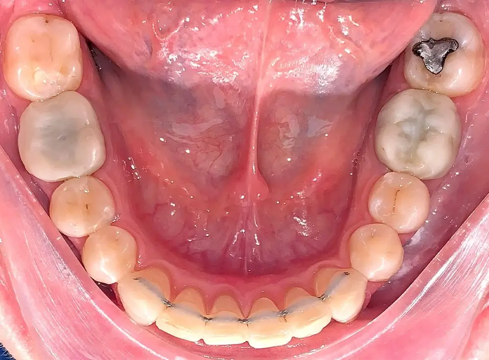 Дистальный прикус - Кейс 10 — нижняя челюсть после лечения