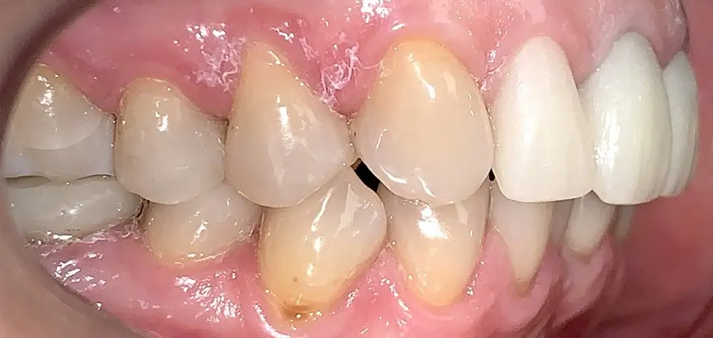 Дистальный прикус - Кейс 10 — боковой ракурс до лечения