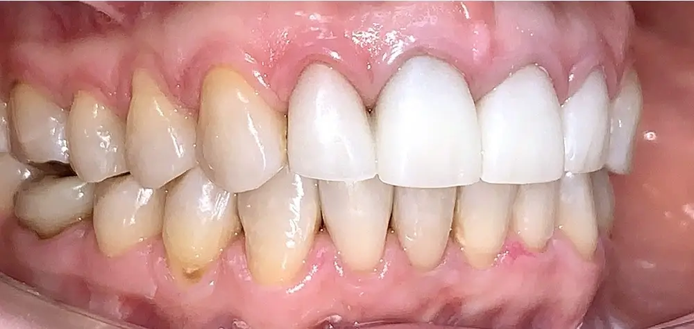 Дистальный прикус - Кейс 10 — боковой ракурс после лечения