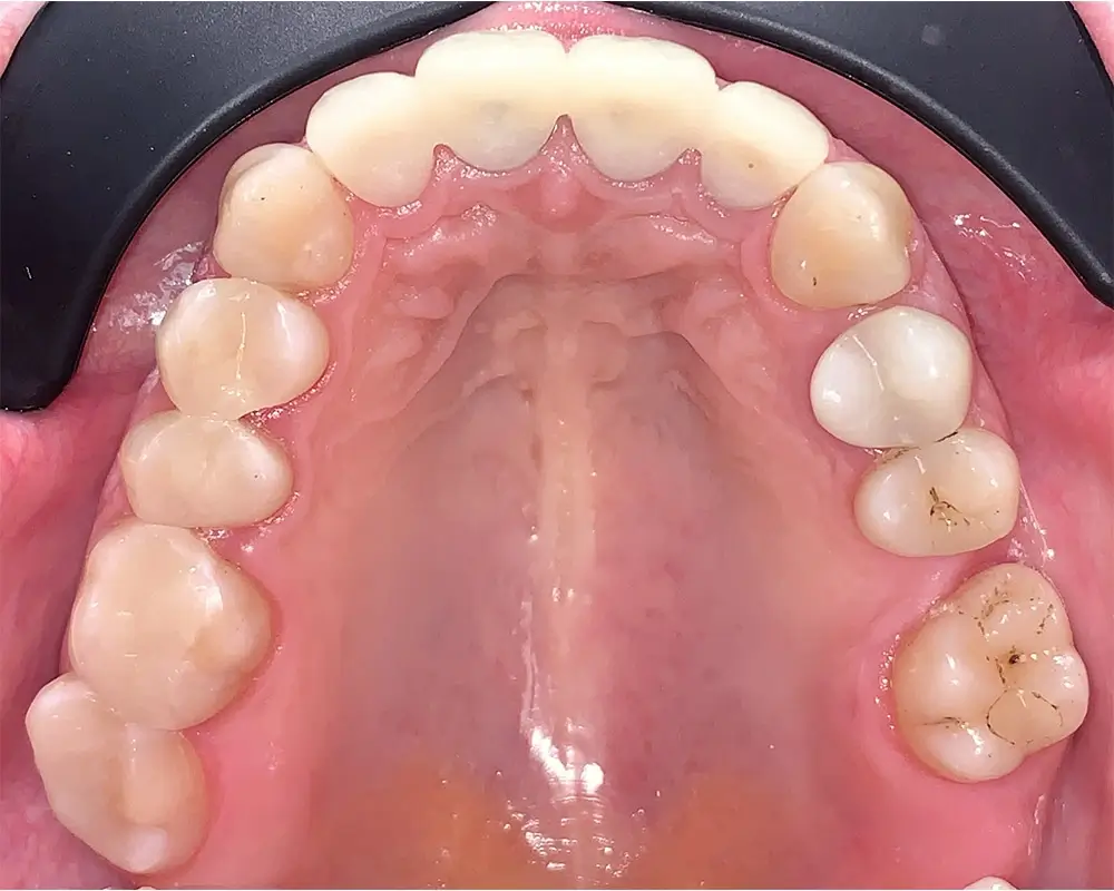 Дистальный прикус - Кейс 10 — верхняя челюсть до лечения
