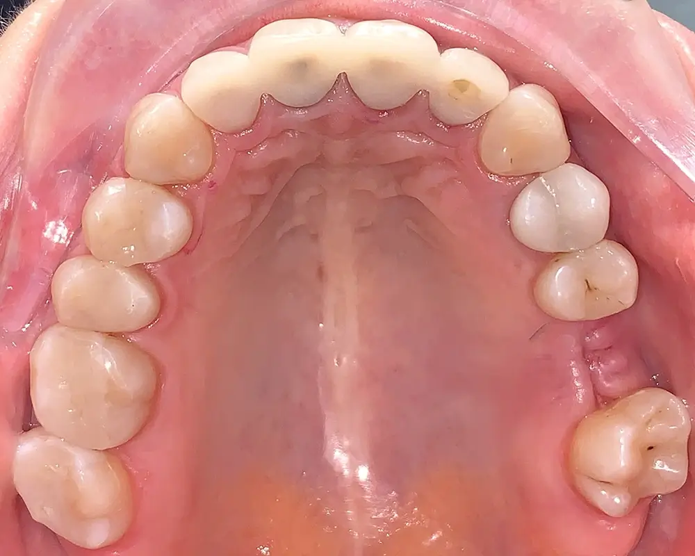 Дистальный прикус - Кейс 10 — верхняя челюсть после лечения