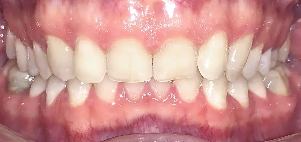 Дистальный прикус - Кейс 11 — вид спереди до лечения