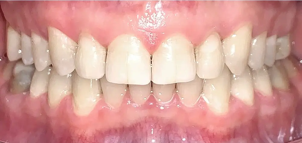 Дистальный прикус - Кейс 11 — вид спереди после лечения