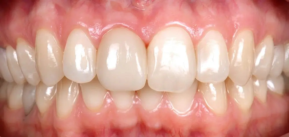 Дистальный прикус - Кейс 12 — вид спереди до лечения