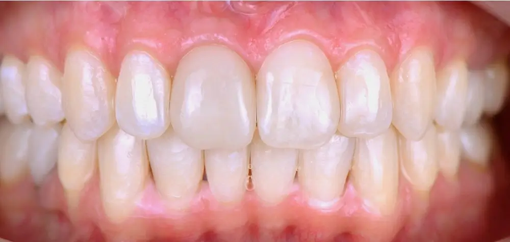 Дистальный прикус - Кейс 12 — вид спереди после лечения