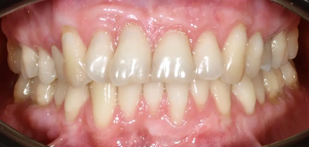 Дистальный прикус - Кейс 13 — вид спереди до лечения