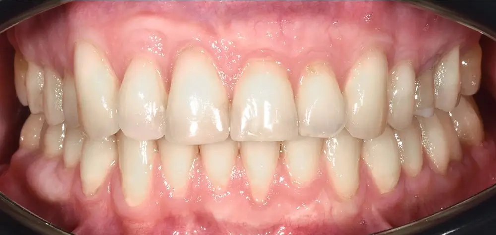Дистальный прикус - Кейс 13 — вид спереди после лечения