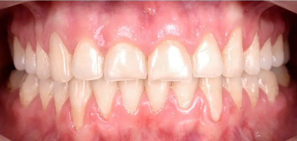 Дистальный прикус - Кейс 14 — вид спереди после лечения