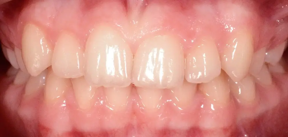 Дистальный прикус - Кейс 15 — вид спереди до лечения