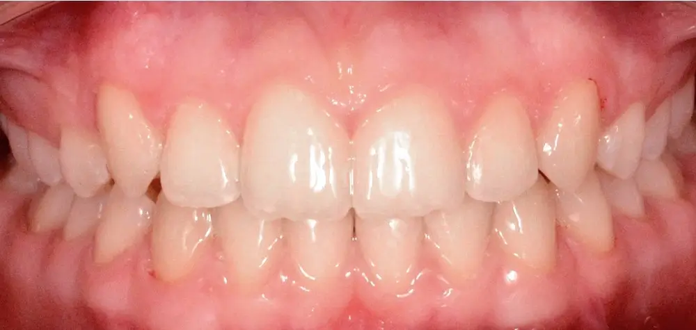 Дистальный прикус - Кейс 15 — вид спереди после лечения