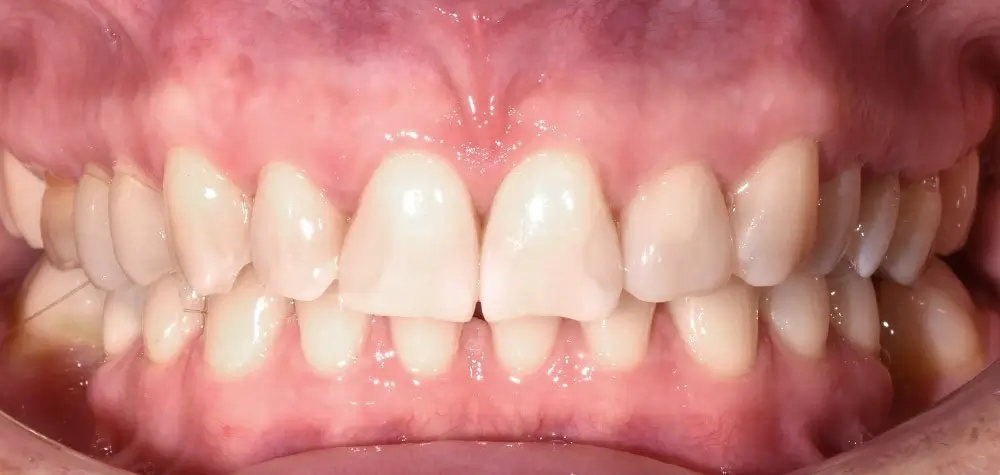 Дистальный прикус - Кейс 16 — вид спереди до лечения