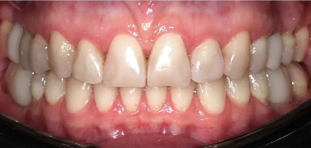 Дистальный прикус - Кейс 16 — вид спереди после лечения
