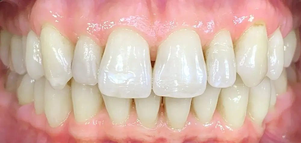 Дистальный прикус - Кейс 17 — фронтальный ракурс до лечения