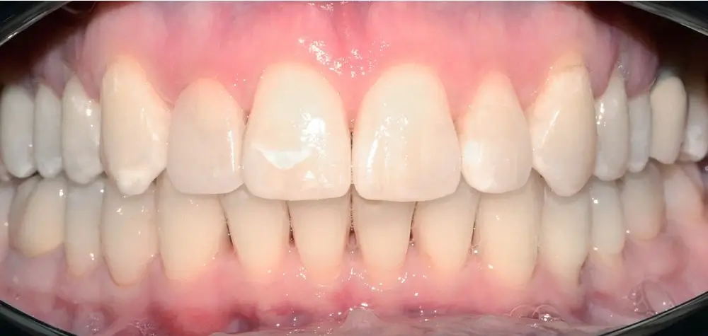 Дистальный прикус - Кейс 17 — фронтальный ракур с после лечения